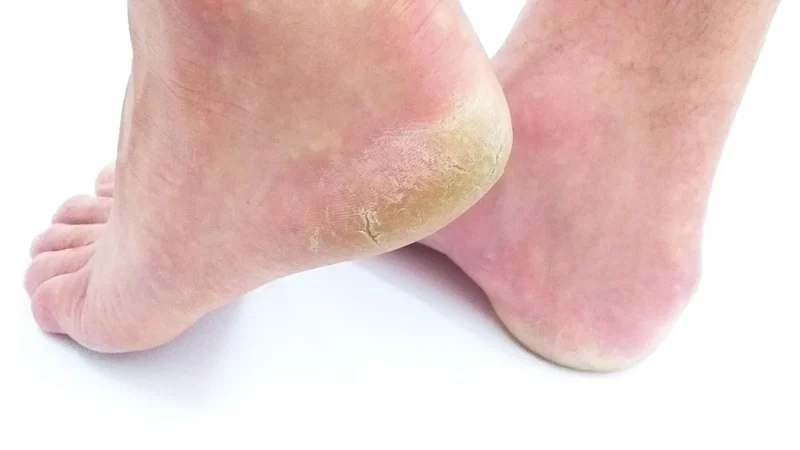 Help4Skin Gojenie pęknięć skóry plaster w żelu 7 ml